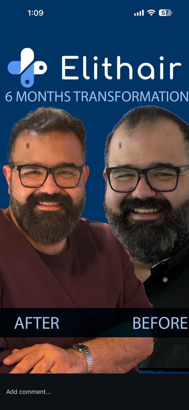 ELIT HAIR , Hair transplant journey